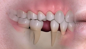Απώλεια δοντιών: Ποιες είναι οι “κρυφές” επιπτώσεις;